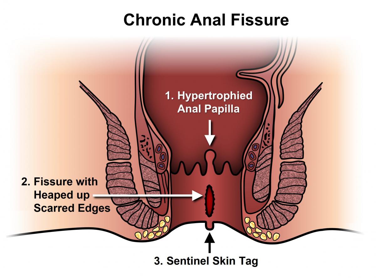 What is chronic anal fissure